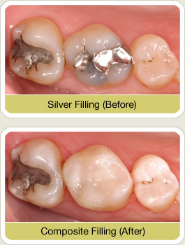 Plastic Fillings  Advantages of Composite Tooth Colored Fillings